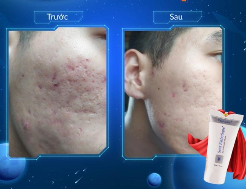 Kiến trúc làn da: ‘vật liệu’ nào giúp tái xây nền da, lấp đầy sẹo lõm? - Ảnh 1.