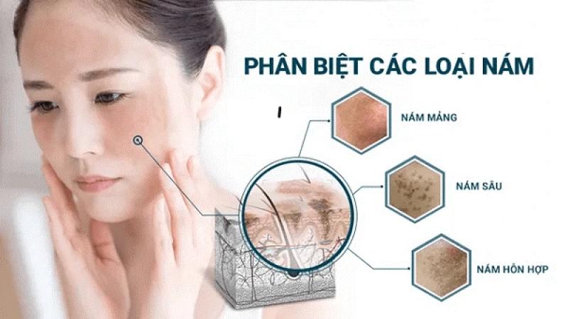 Gợi ý cách trị nám chân sâu, nám mảng... hiệu quả tại nhà không cần xâm lấn- Ảnh 2. Gợi ý cách trị nám chân sâu, nám mảng... hiệu quả tại nhà không cần xâm lấn- Ảnh 2.