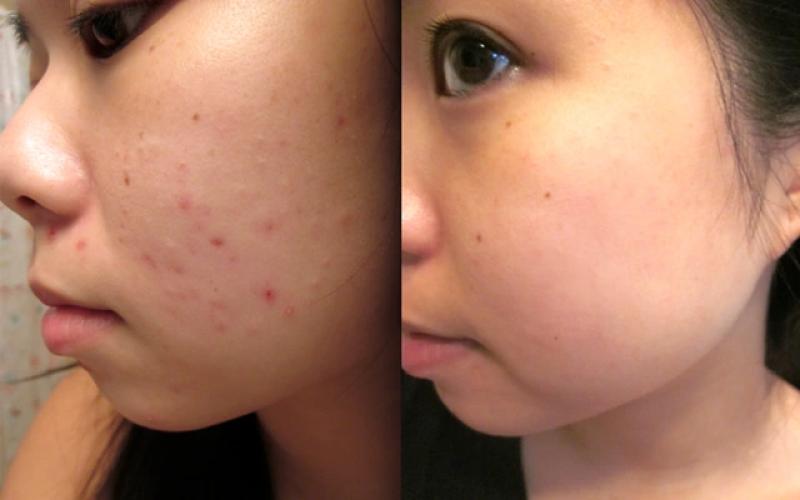 Bật mí cách trị thâm mụn hiệu quả tại nhà, kể cả thâm nặng và lâu năm- Ảnh 2. Bật mí cách trị thâm mụn hiệu quả tại nhà, kể cả thâm nặng và lâu năm- Ảnh 2.