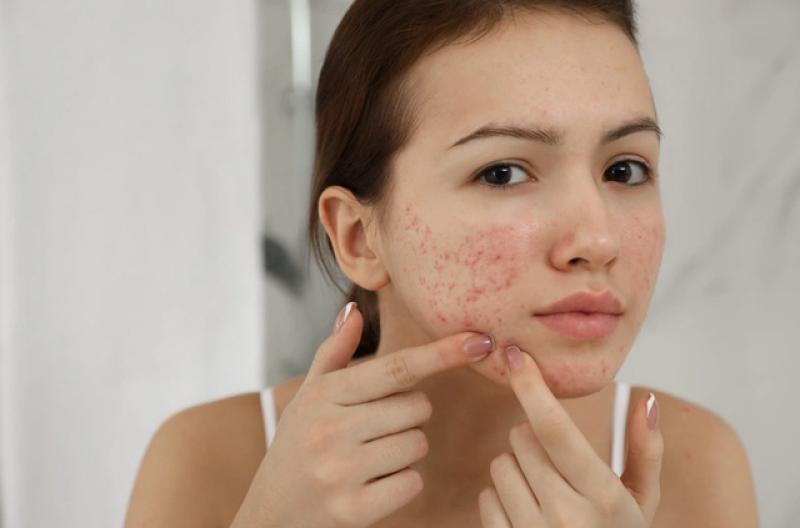 Bật mí cách trị thâm mụn hiệu quả tại nhà, kể cả thâm nặng và lâu năm- Ảnh 3. Bật mí cách trị thâm mụn hiệu quả tại nhà, kể cả thâm nặng và lâu năm- Ảnh 3.