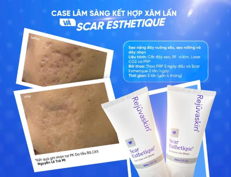 Kiến trúc làn da: ‘vật liệu’ nào giúp tái xây nền da, lấp đầy sẹo lõm? - Ảnh 4.