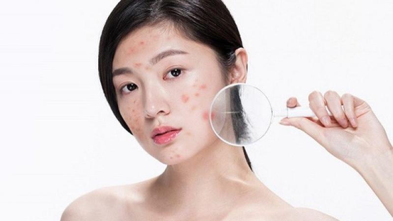 Bật mí cách trị thâm mụn hiệu quả tại nhà, kể cả thâm nặng và lâu năm- Ảnh 4. Bật mí cách trị thâm mụn hiệu quả tại nhà, kể cả thâm nặng và lâu năm- Ảnh 4.