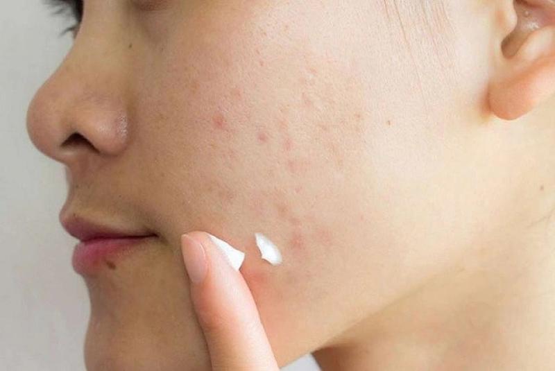 Bật mí cách trị thâm mụn hiệu quả tại nhà, kể cả thâm nặng và lâu năm- Ảnh 5. Bật mí cách trị thâm mụn hiệu quả tại nhà, kể cả thâm nặng và lâu năm- Ảnh 5.