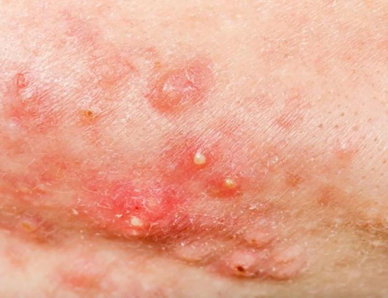 Scar Esthetique: Giải pháp kích tăng sinh collagen cho sẹo lõm mịn da- Ảnh 2. Scar Esthetique: Giải pháp kích tăng sinh collagen cho sẹo lõm mịn da- Ảnh 2.