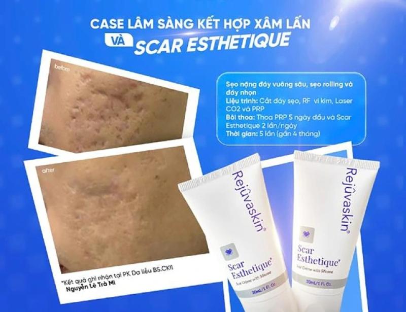 Scar Esthetique: Giải pháp kích tăng sinh collagen cho sẹo lõm mịn da- Ảnh 7. Scar Esthetique: Giải pháp kích tăng sinh collagen cho sẹo lõm mịn da- Ảnh 7.