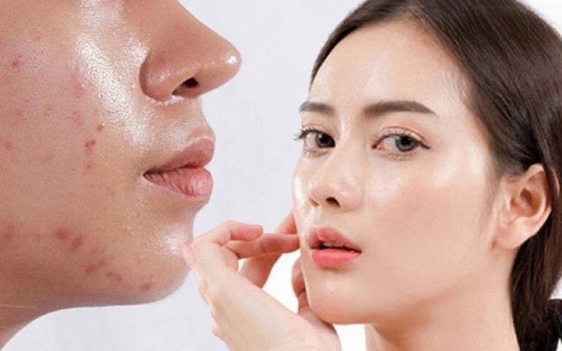 Top 7 kem chống nắng cho da dầu mụn khô thoáng, không bóng nhờn, không gây mụn - Ảnh 1.