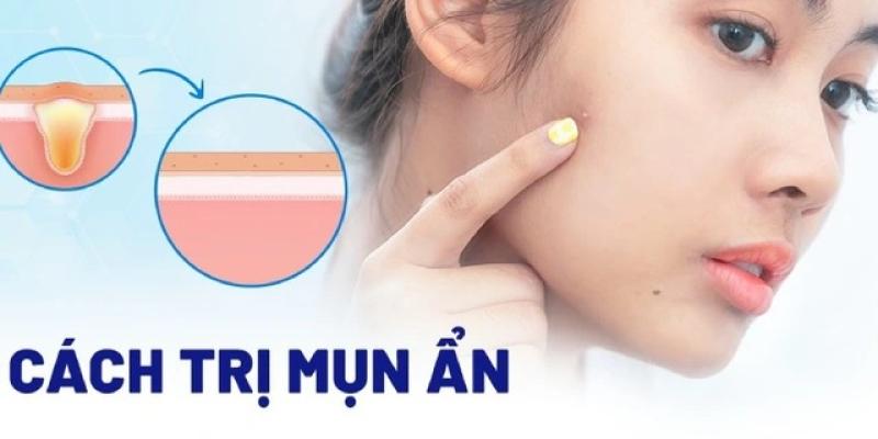 Bật mí cách trị mụn ẩn hiệu quả tại nhà, ngừa tái phát, không để lại sẹo - Ảnh 1.