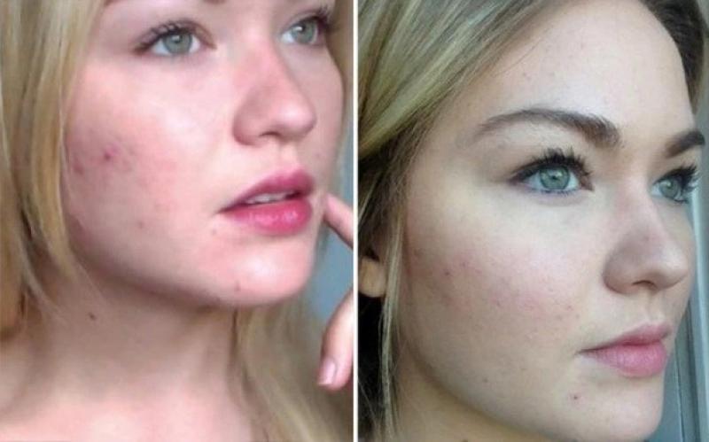 Gợi ý cách trị mụn bọc chuẩn y khoa hiệu quả tại nhà, ngăn ngừa sẹo xấu- Ảnh 1. Gợi ý cách trị mụn bọc chuẩn y khoa hiệu quả tại nhà, ngăn ngừa sẹo xấu- Ảnh 1.