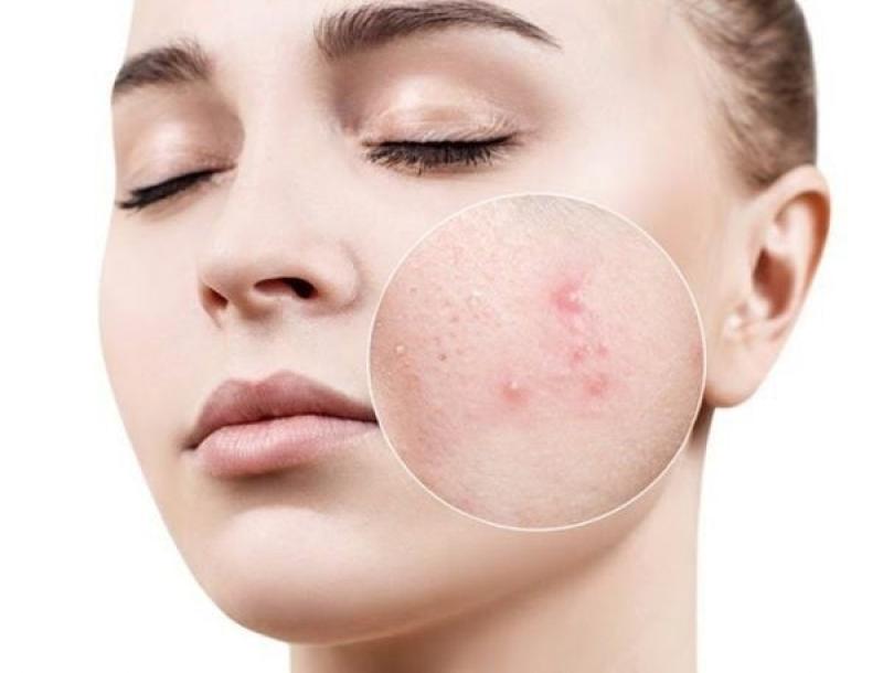 Gợi ý cách trị mụn bọc chuẩn y khoa hiệu quả tại nhà, ngăn ngừa sẹo xấu- Ảnh 2. Gợi ý cách trị mụn bọc chuẩn y khoa hiệu quả tại nhà, ngăn ngừa sẹo xấu- Ảnh 2.