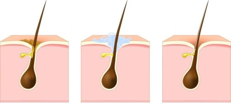 Gợi ý cách trị mụn bọc chuẩn y khoa hiệu quả tại nhà, ngăn ngừa sẹo xấu- Ảnh 3. Gợi ý cách trị mụn bọc chuẩn y khoa hiệu quả tại nhà, ngăn ngừa sẹo xấu- Ảnh 3.