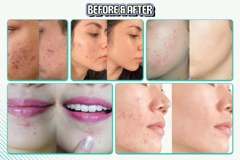 Trị mụn cấp tốc có thực sự an toàn? Lợi ích và tác hại bạn cần biết- Ảnh 1. Trị mụn cấp tốc có thực sự an toàn? Lợi ích và tác hại bạn cần biết- Ảnh 1.