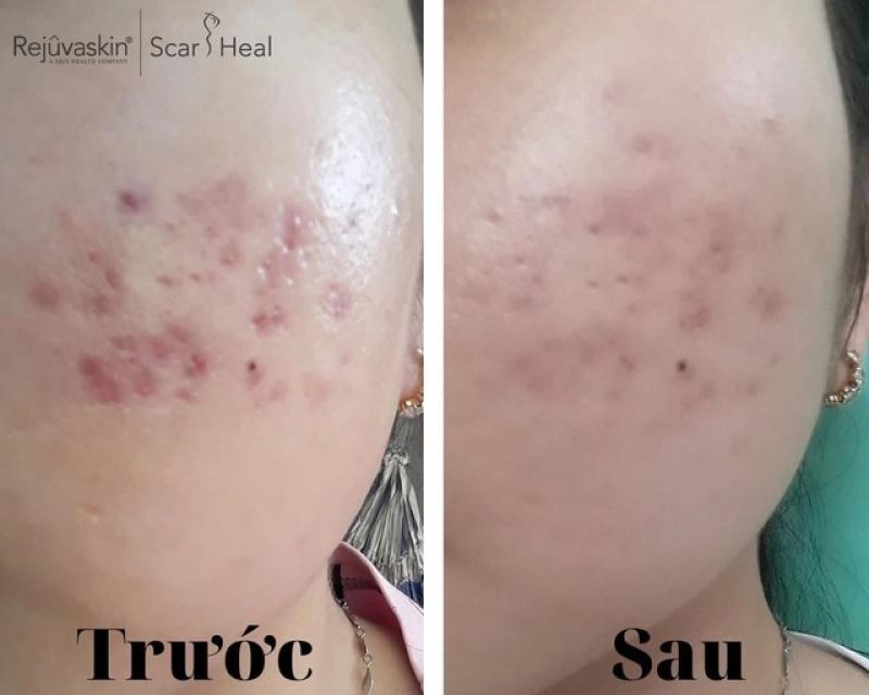 Có cách nào trị thâm sẹo lâu năm hiệu quả tại nhà, tốn ít chi phí?- Ảnh 1. Có cách nào trị thâm sẹo lâu năm hiệu quả tại nhà, tốn ít chi phí?- Ảnh 1.