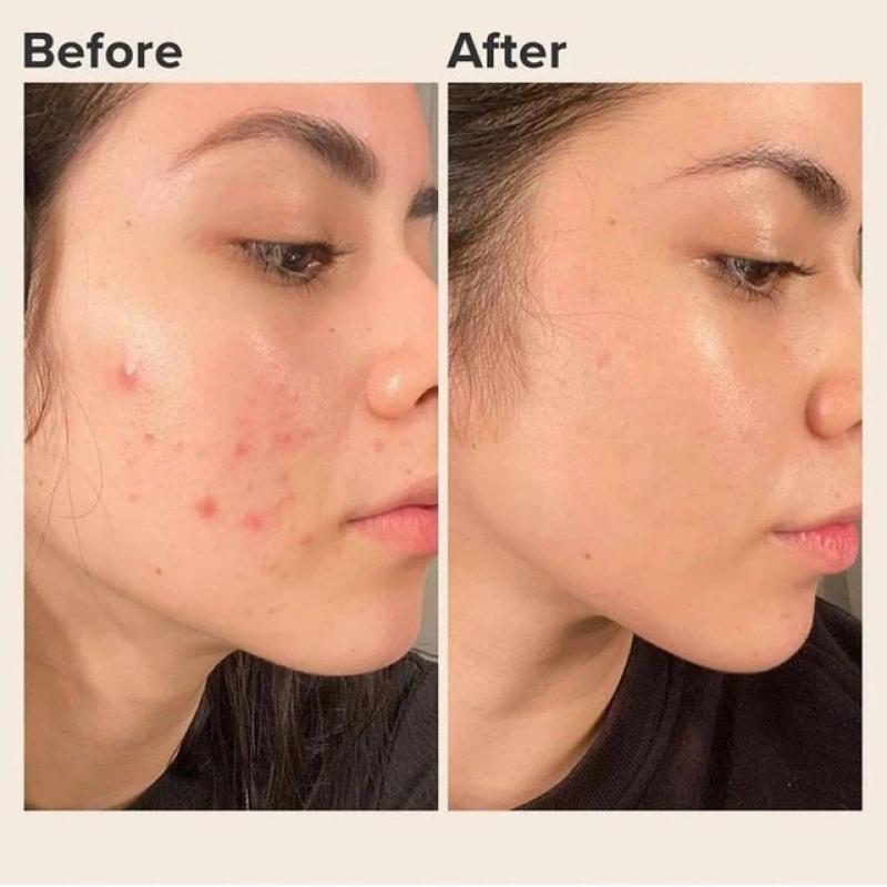 Trị mụn cấp tốc có thực sự an toàn? Lợi ích và tác hại bạn cần biết- Ảnh 2. Trị mụn cấp tốc có thực sự an toàn? Lợi ích và tác hại bạn cần biết- Ảnh 2.