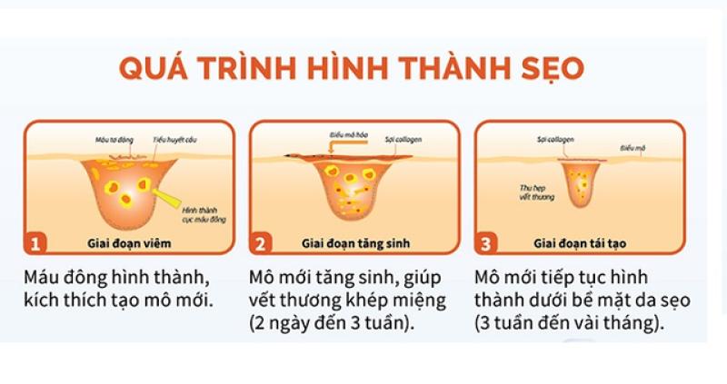 Cách ngừa sẹo và trị sẹo chuẩn y khoa hiệu quả tại nhà không cần xâm lấn - Ảnh 2.
