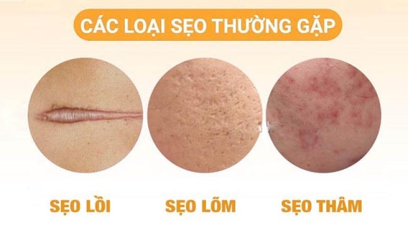 Cách ngừa sẹo và trị sẹo chuẩn y khoa hiệu quả tại nhà không cần xâm lấn - Ảnh 3.