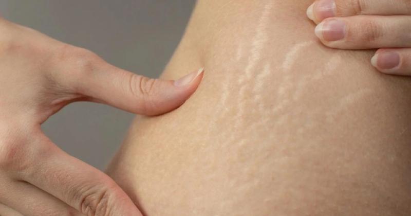 Rạn da không chỉ là chuyện của mẹ bầu!- Ảnh 3. Rạn da không chỉ là chuyện của mẹ bầu!- Ảnh 3.