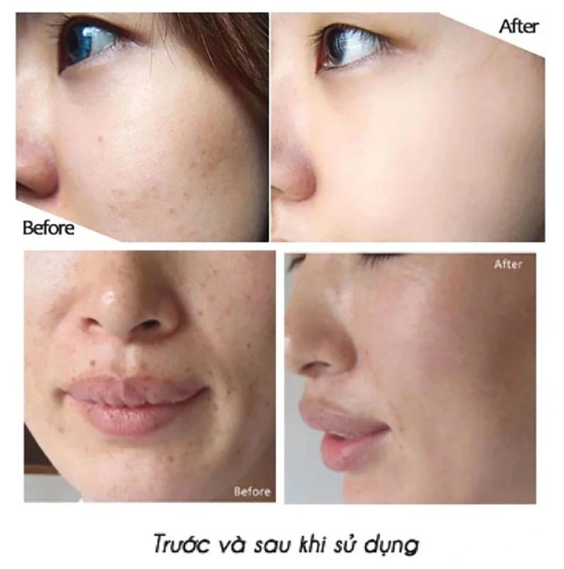 Top 7 kem trị nám cho da nhạy cảm, không gây kích ứng, không bong tróc - Ảnh 3.
