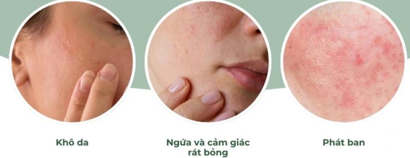 Trị mụn cấp tốc có thực sự an toàn? Lợi ích và tác hại bạn cần biết- Ảnh 4. Trị mụn cấp tốc có thực sự an toàn? Lợi ích và tác hại bạn cần biết- Ảnh 4.