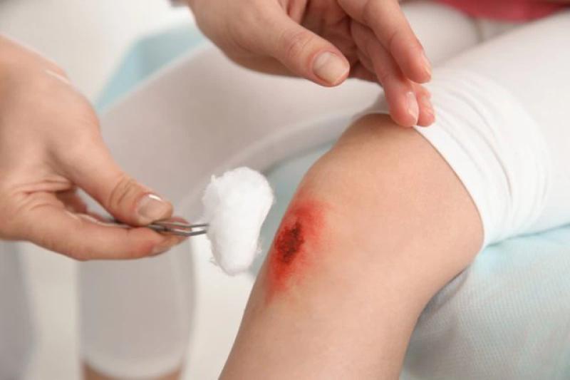 Cách ngừa sẹo và trị sẹo chuẩn y khoa hiệu quả tại nhà không cần xâm lấn - Ảnh 4.