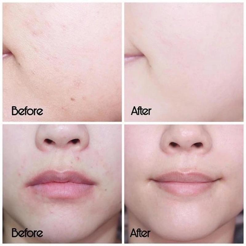 Top 5 kem dưỡng phục hồi sau trị mụn ai cũng 'mê' ngay lần đầu tiên- Ảnh 1. Top 5 kem dưỡng phục hồi sau trị mụn ai cũng 'mê' ngay lần đầu tiên- Ảnh 1.
