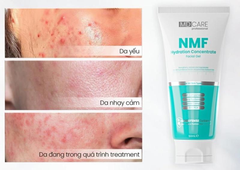 Top 5 kem dưỡng phục hồi sau trị mụn ai cũng 'mê' ngay lần đầu tiên- Ảnh 4. Top 5 kem dưỡng phục hồi sau trị mụn ai cũng 'mê' ngay lần đầu tiên- Ảnh 4.