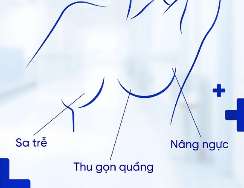 Những sai lầm cần tránh để có vết sẹo đẹp sau nâng ngực - Ảnh 1.