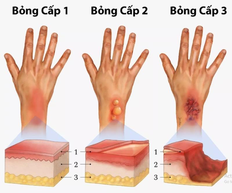 Bật mí cách trị sẹo bỏng chuẩn y khoa hiệu quả ngay tại nhà - Ảnh 2.