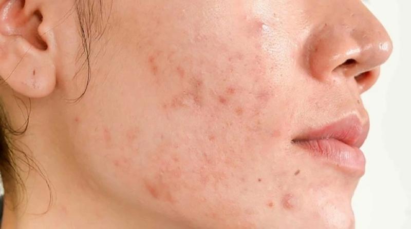 Bật mí cách trị thâm sau khi nặn mụn chuẩn y khoa hiệu quả ngay tại nhà- Ảnh 3. Bật mí cách trị thâm sau khi nặn mụn chuẩn y khoa hiệu quả ngay tại nhà- Ảnh 3.
