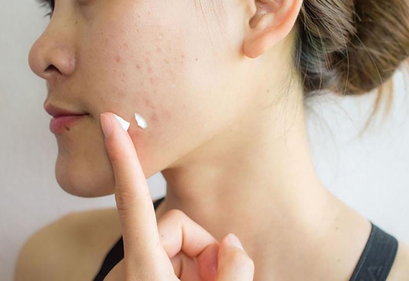Bật mí cách trị thâm sau khi nặn mụn chuẩn y khoa hiệu quả ngay tại nhà- Ảnh 5. Bật mí cách trị thâm sau khi nặn mụn chuẩn y khoa hiệu quả ngay tại nhà- Ảnh 5.