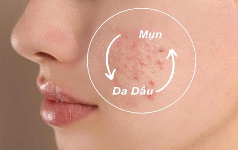 Top 7 sữa rửa mặt cho da dầu mụn sạch mịn, dịu nhẹ đang được mua nhiều - Ảnh 1.