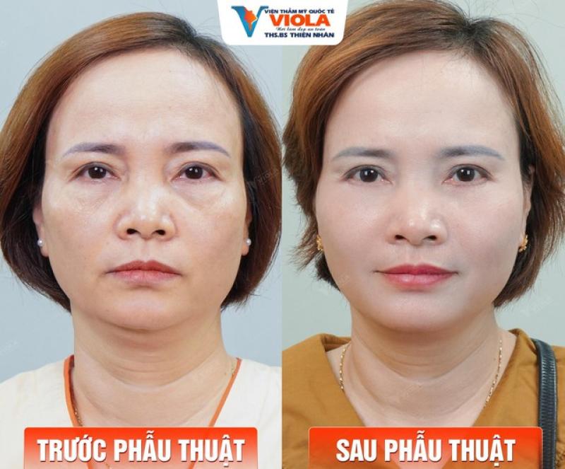 Căng da trẻ hóa khuôn mặt thời đại 4.0 tại Viện Thẩm mỹ Quốc tế Viola - Ảnh 2.