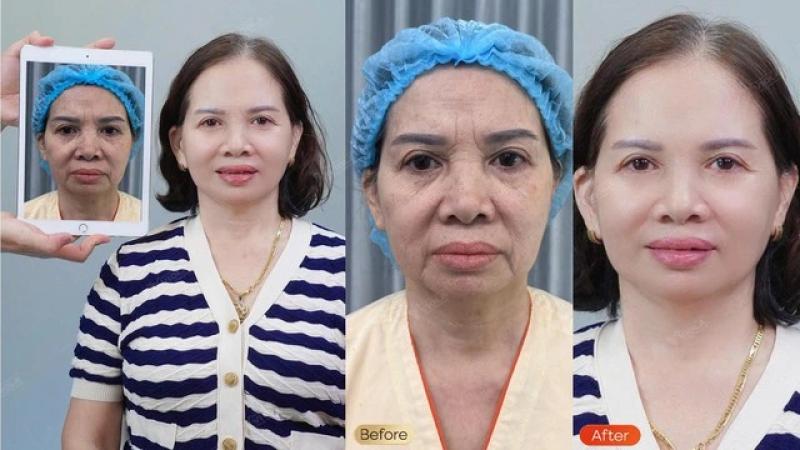 Căng da trẻ hóa khuôn mặt thời đại 4.0 tại Viện Thẩm mỹ Quốc tế Viola - Ảnh 3.