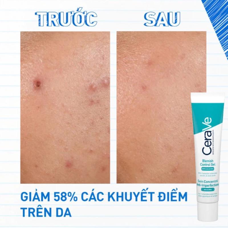 Cách sử dụng kem trị mụn hiệu quả, ngăn ngừa tái phát - Ảnh 10.