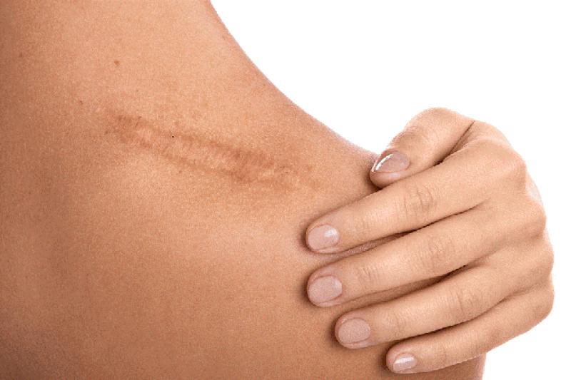 Chăm sóc và điều trị sẹo lồi tại nhà bằng các sản phẩm dược mỹ phẩm- Ảnh 2. Chăm sóc và điều trị sẹo lồi tại nhà bằng các sản phẩm dược mỹ phẩm- Ảnh 2.
